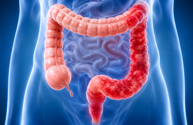 Colitis
