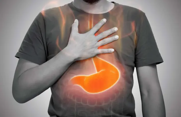 Acid Reflux